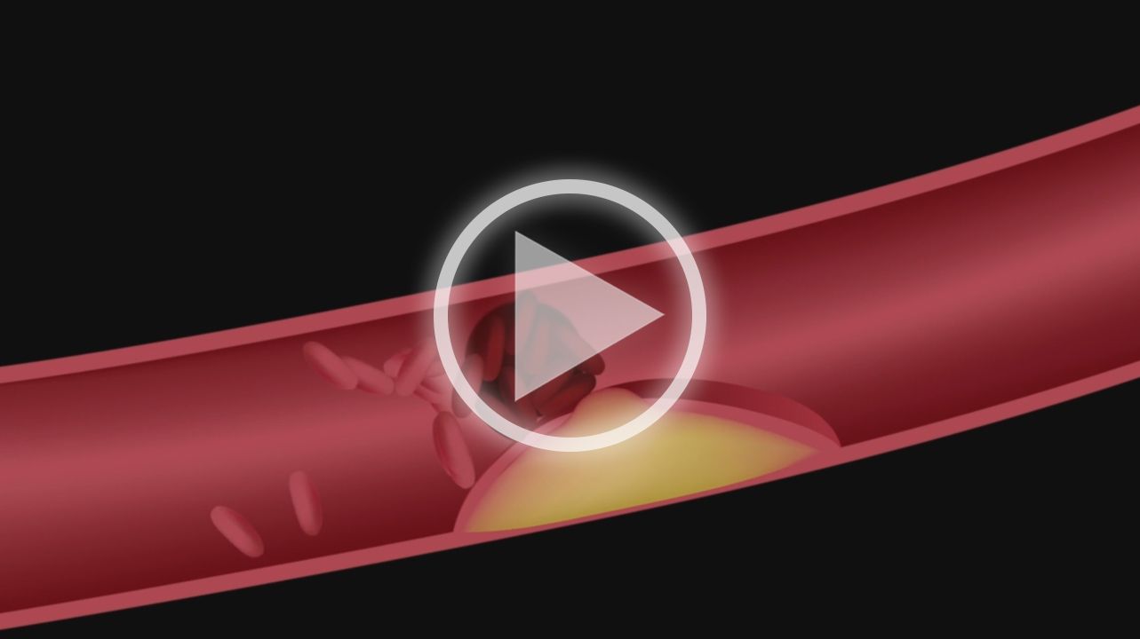 Atherosclerosis