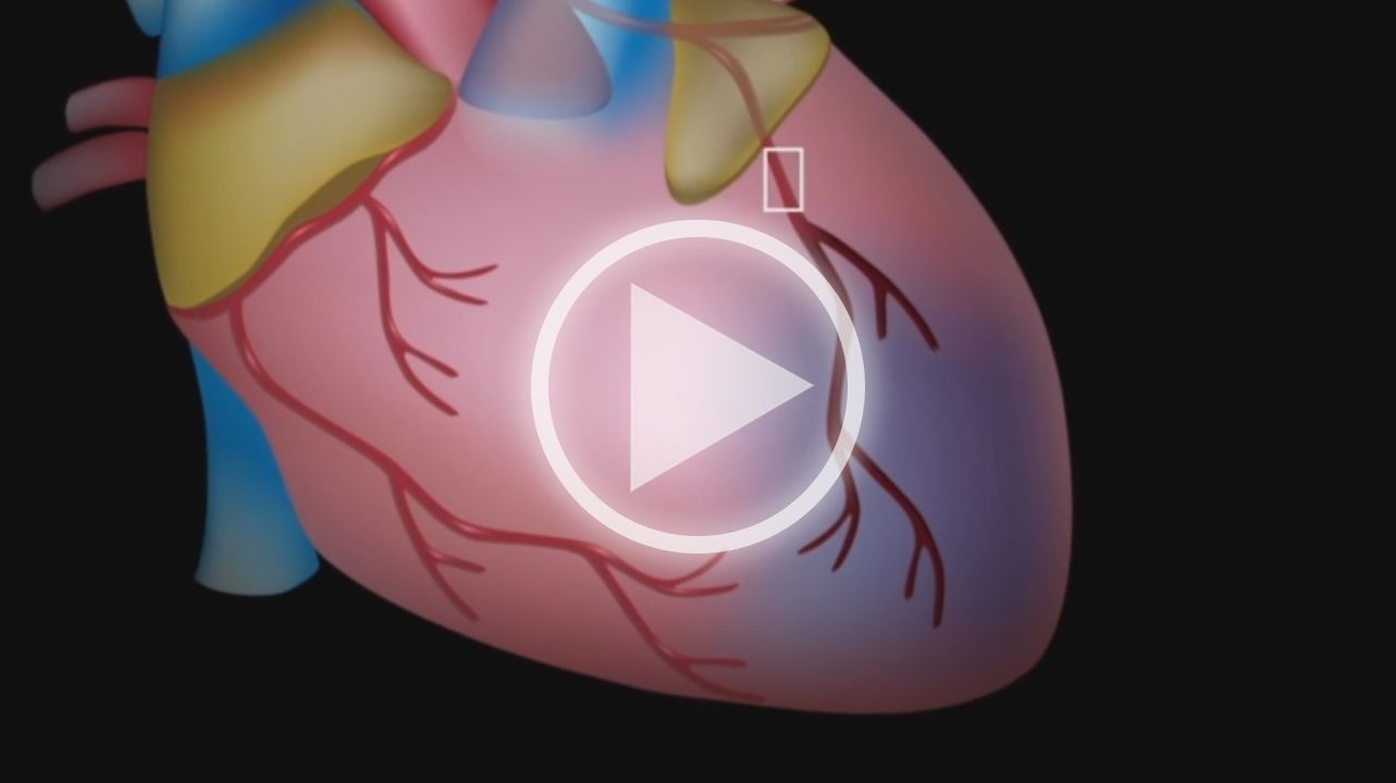 Myocardial Infarction